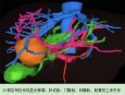 兰州市第二人民医院成功运用3D数字影像规划系统为肝脏手术精准导航